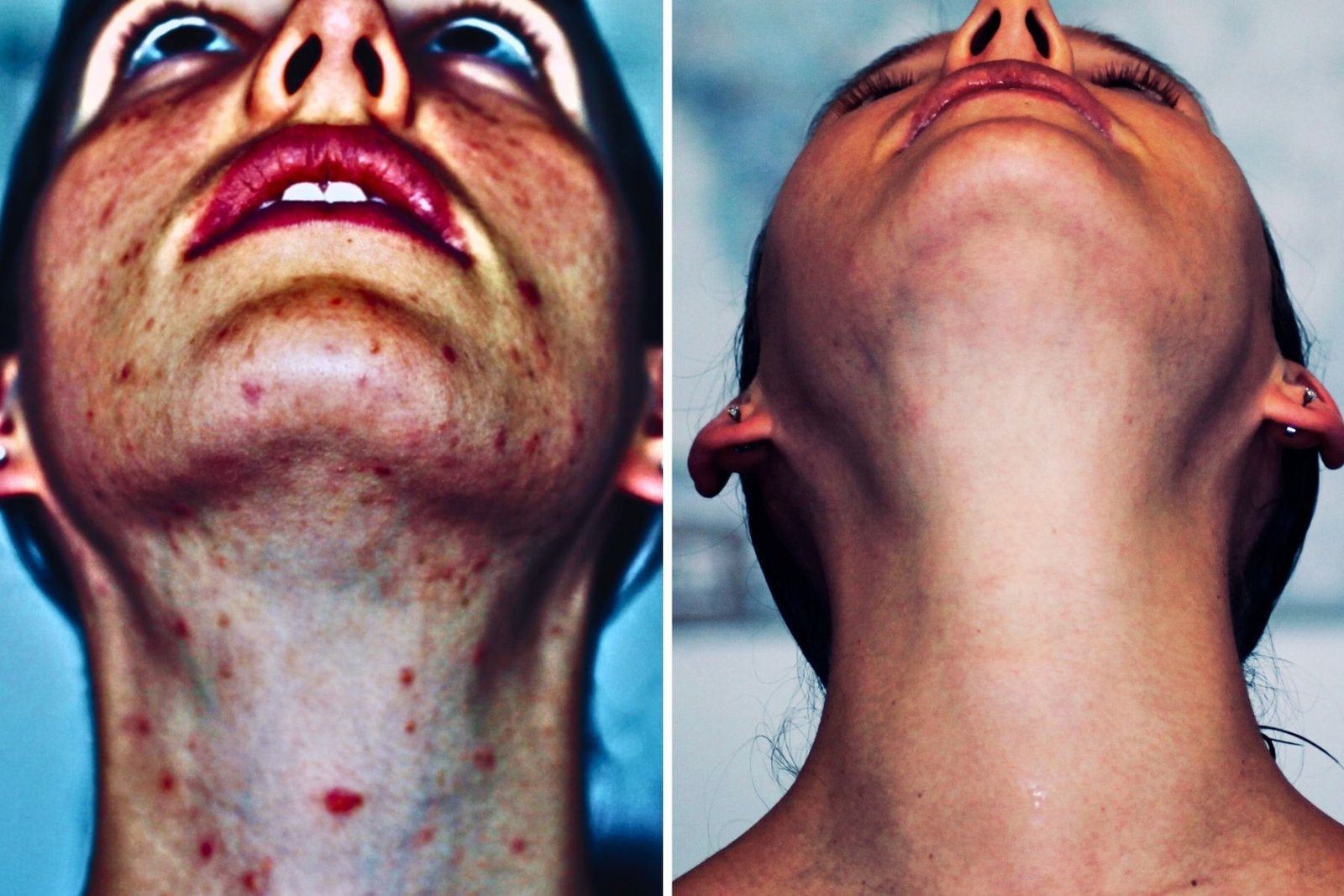 Akne vorher nachher Vergleich der Hautveränderung durch Ernährung